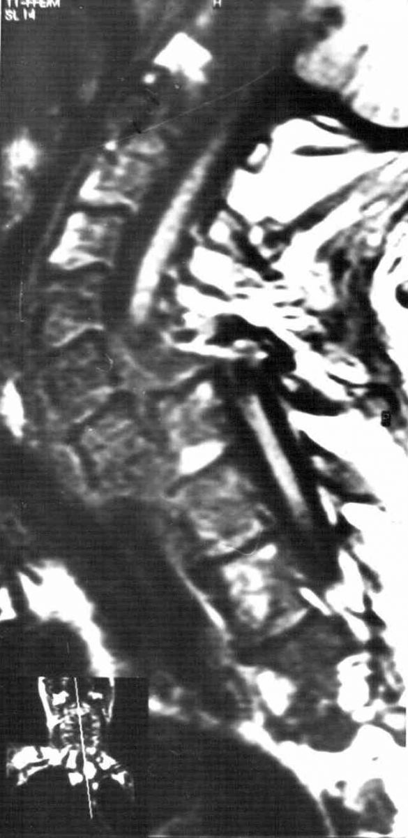 Повреждения позвоночника, осложненные травмой спинного мозга